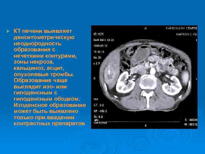 Как выглядит раковая опухоль почки на узи