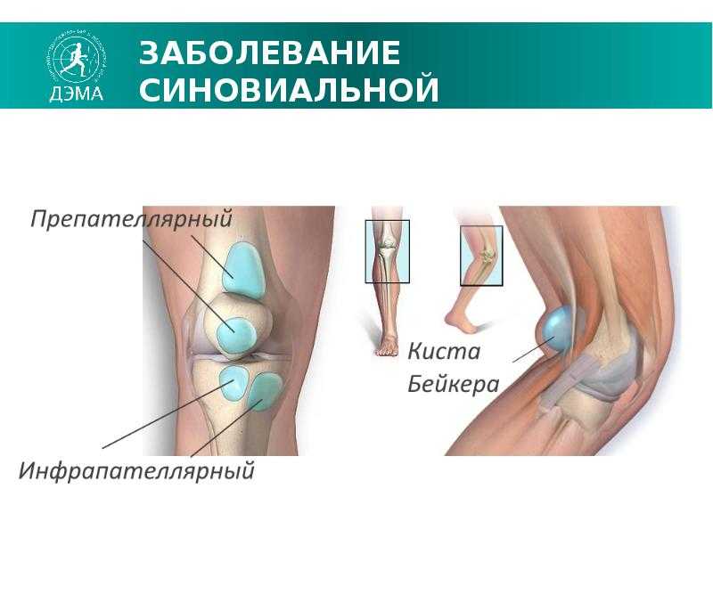 Заострение межмыщелковых бугорков коленного сустава: причины и лечение