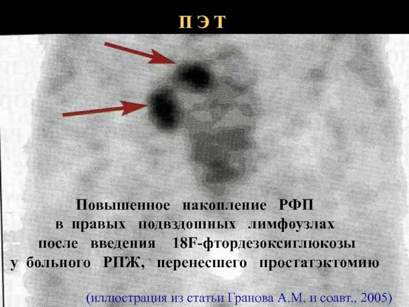 Накопление рфп в головном мозге: причины, симптомы и лечение