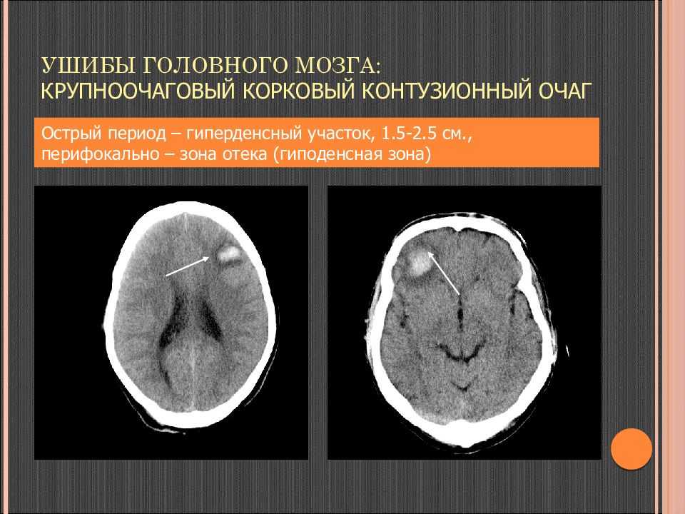 Гиподенсный очаг: что это такое, округлая зона на снимке