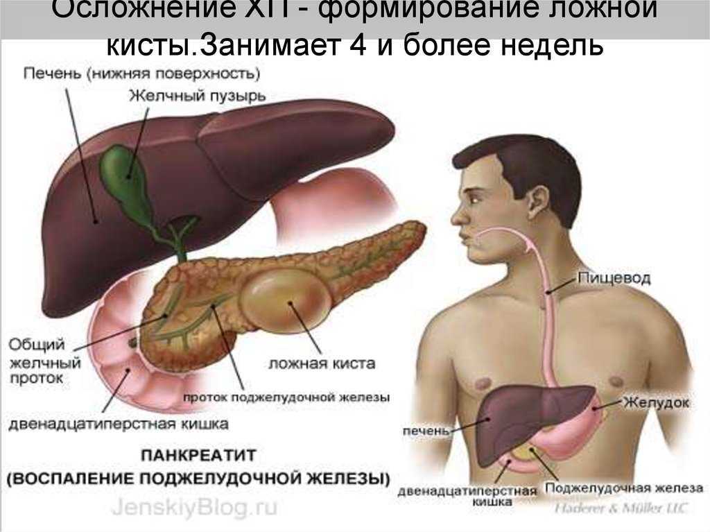 Псевдокиста поджелудочной железы: эндоскопическое лечение и симптомы, чем лечить псевдокисту поджелудочной железы? | клиники «евроонко»