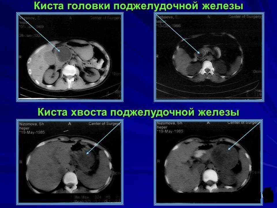 Билиарный панкреатит — что это, методы диагностики и лечения заболевания | все о печени.ру